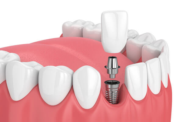 Dental Implants Aberdeen